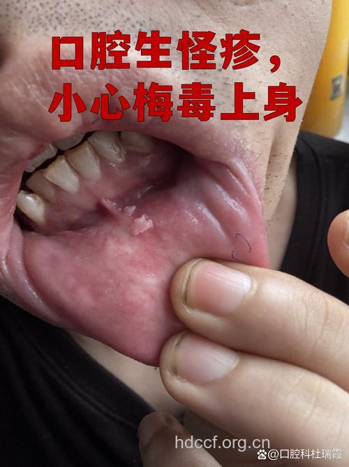 感染梅毒的口腔皮肤症状