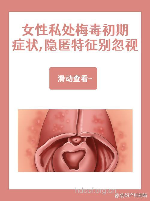 女性早期梅毒有什么症状