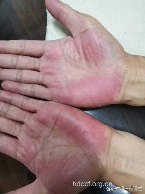 先天性梅毒肝硬化的症状有哪些