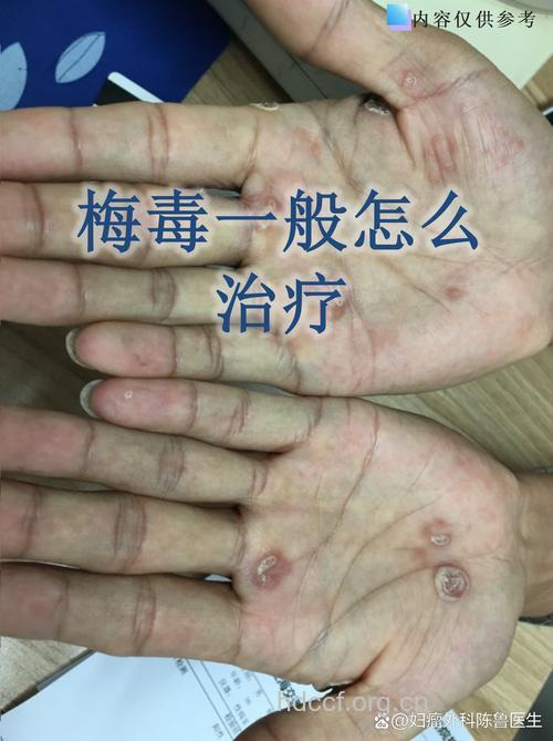 治疗梅毒的特殊疗法