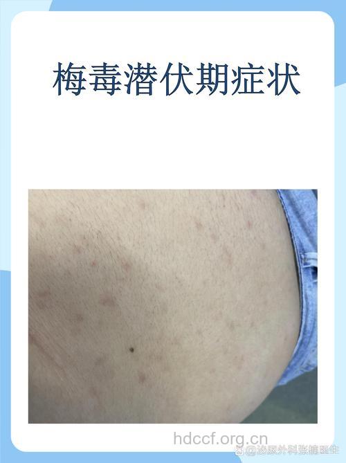 梅毒的潜伏期有哪些表现