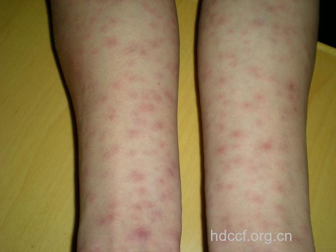 梅毒的典型症状表现是哪些