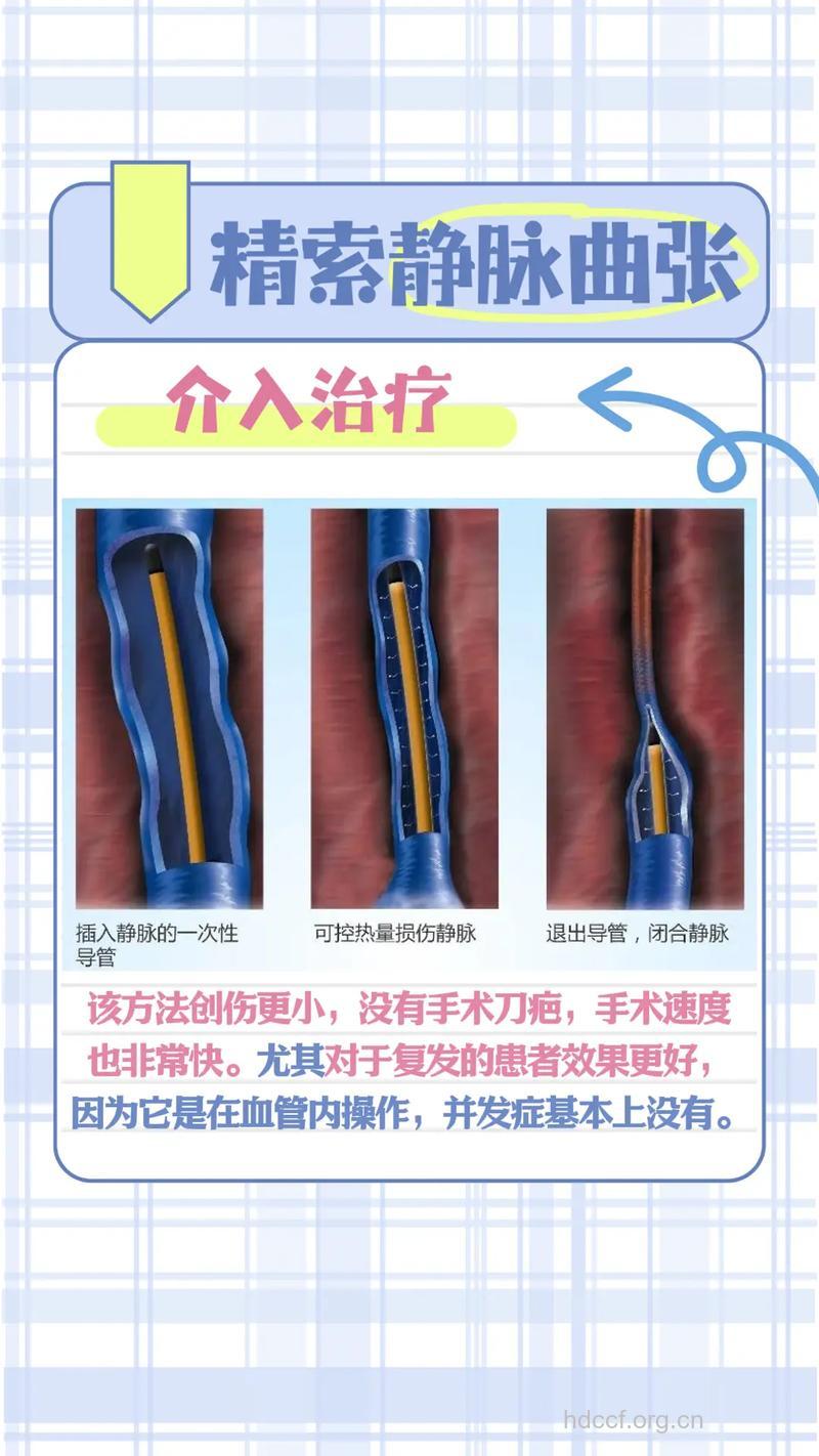 精索静脉曲张的治疗方法