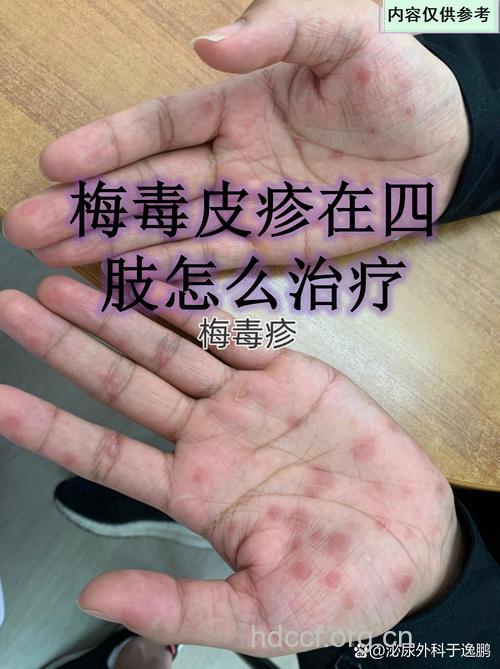 怎么进行梅毒治疗方法