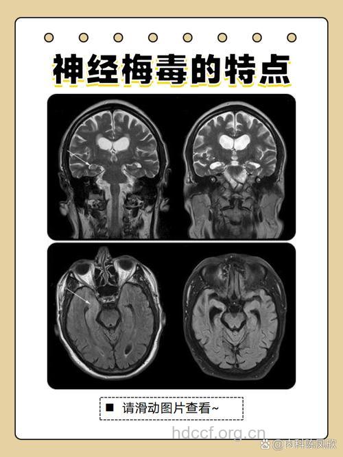 梅毒对大脑有哪些损害
