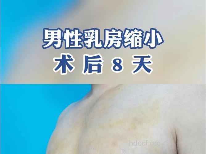 男性乳房发育可采用乳房缩小整形术