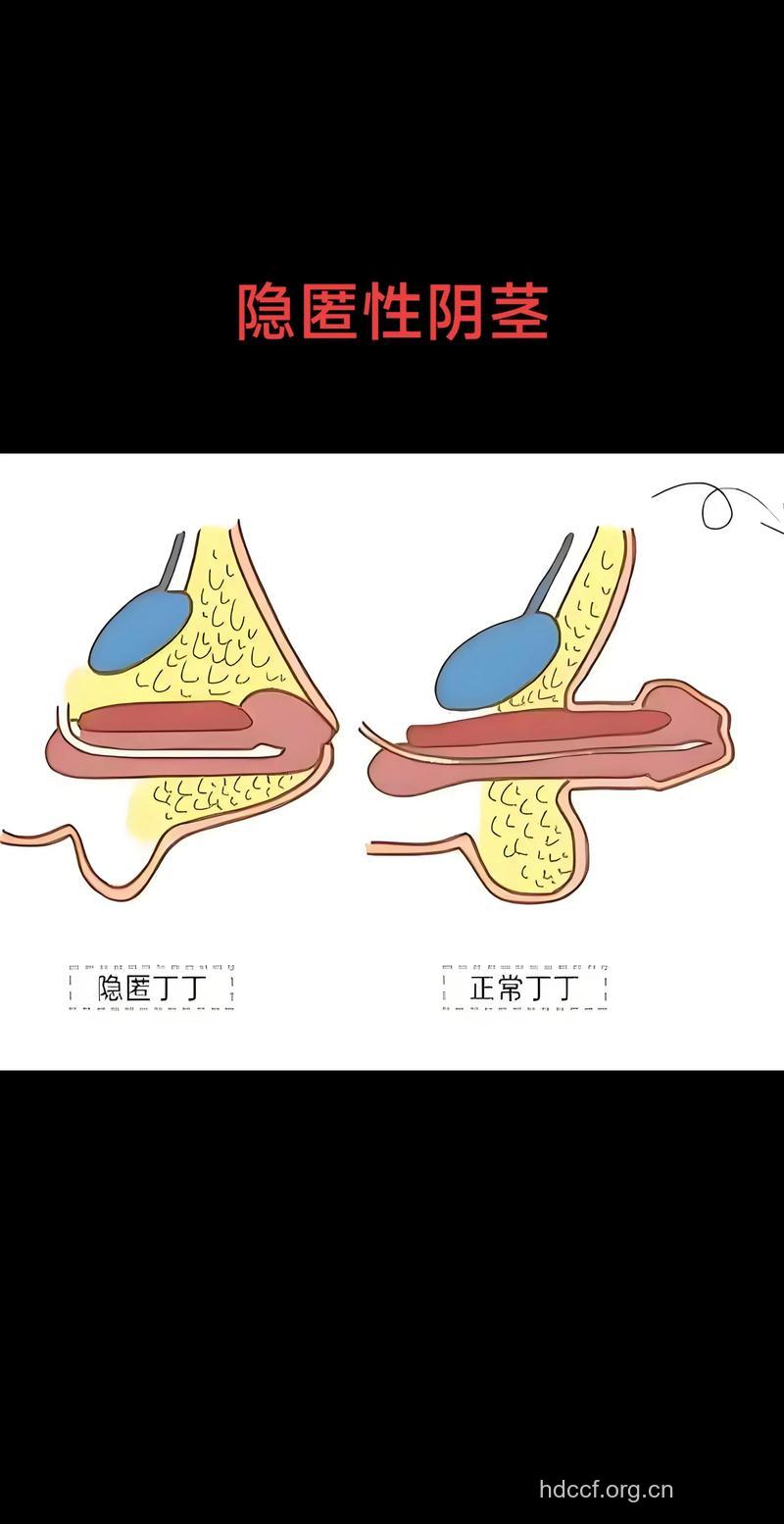 阴茎畸形的治疗