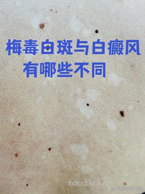 怎么区别梅毒白斑和白癜风方法