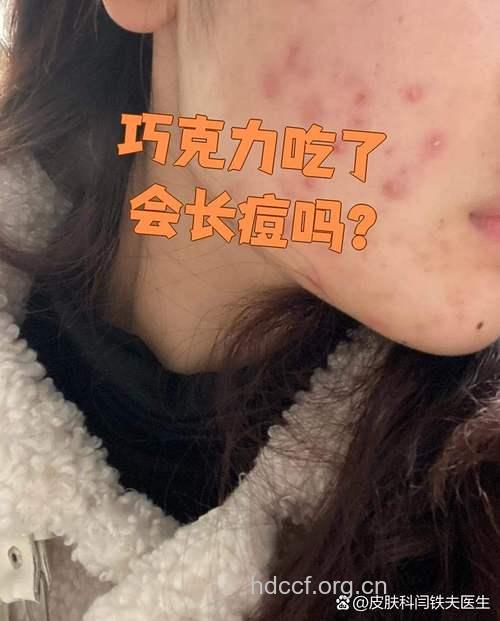 吃巧克力会长青春痘吗