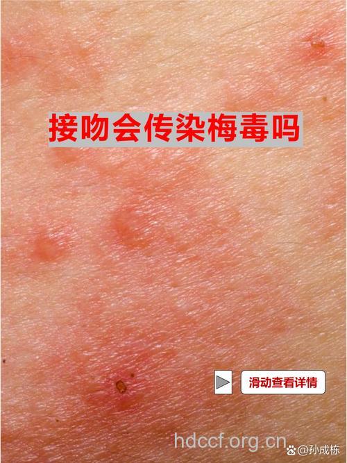 为什么接吻会导致梅毒