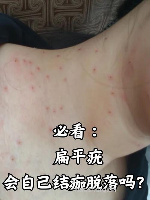 什么是扁平湿疣