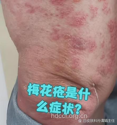 什么是“梅花疹”
