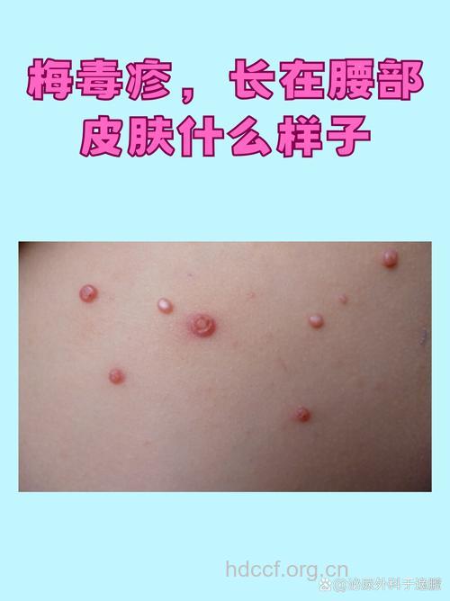 扁平湿疣梅毒有哪些症状
