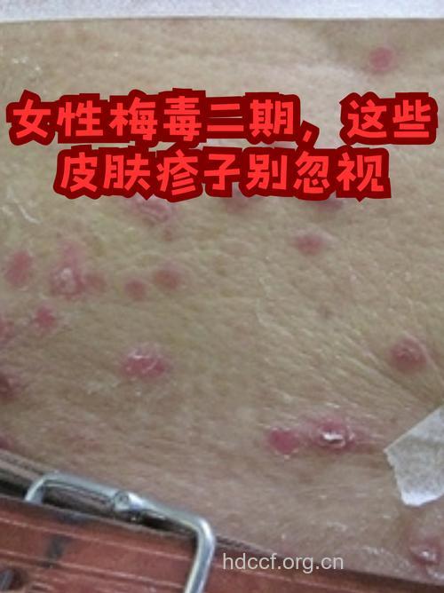 二期梅毒有哪些特点