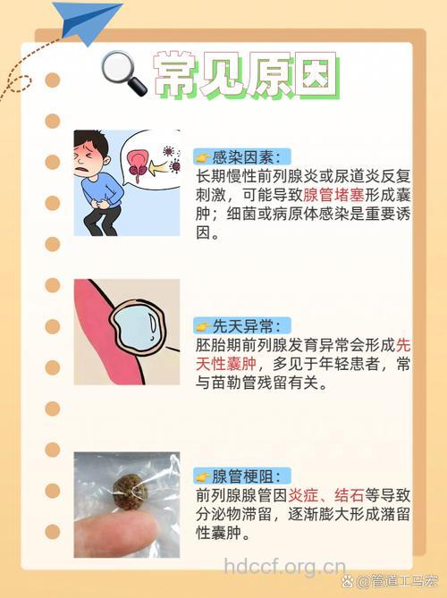 出现3个症状可能就是前列腺囊肿来袭