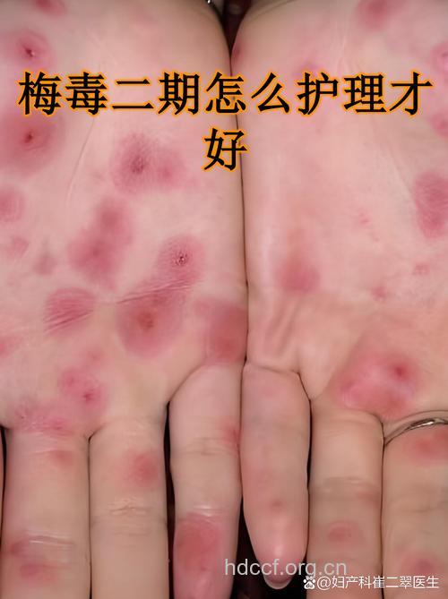 二期梅毒能不能治好呢?