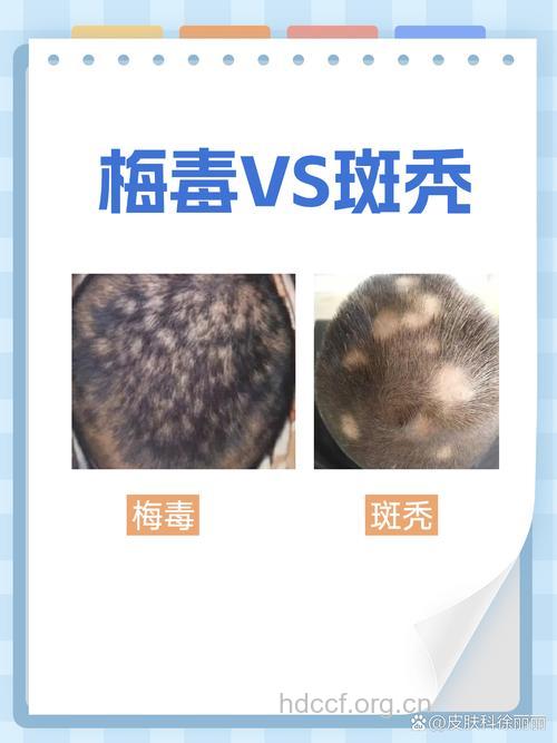 梅毒与脱发有直接关系吗