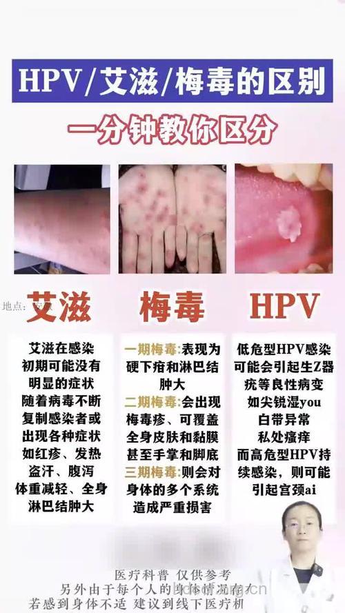认清痔疮与梅毒的区别