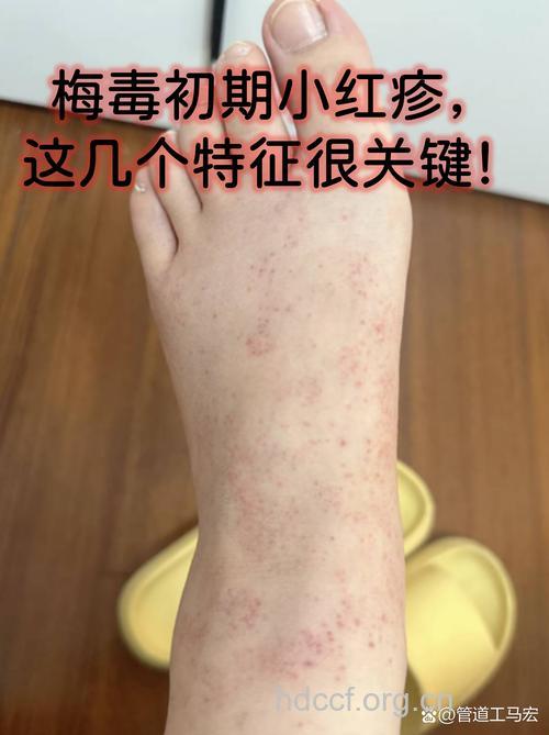 什么是梅毒疹