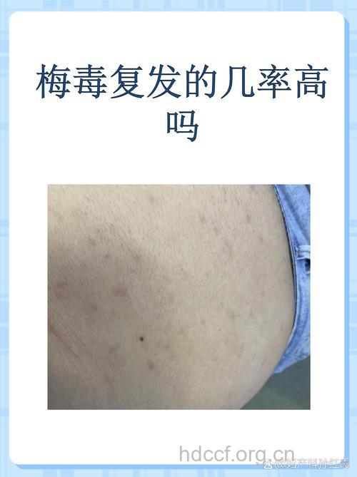 为什么梅毒的复发率居高不下