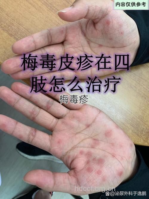 二期梅毒疹的特征如何