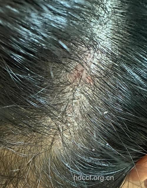 头皮屑突增竟是梅毒作怪