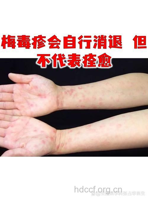 危机：梅毒越来越难治愈