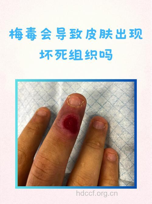 案例：为爱讨清白 霉菌非梅毒