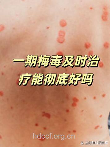 治好梅毒的几率有多大？