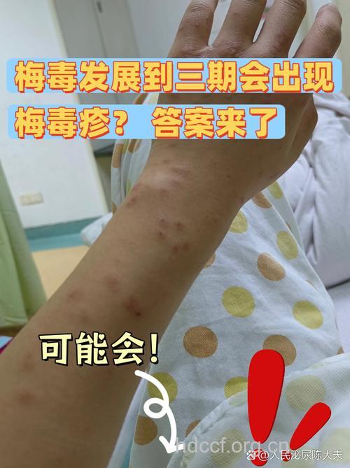 三期梅毒 为时已晚？