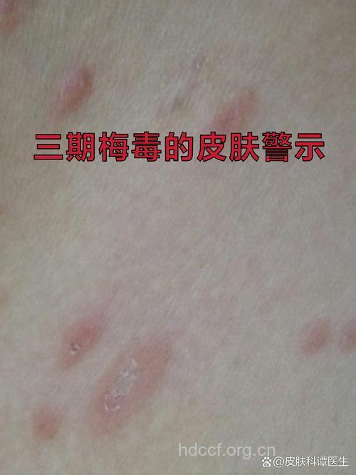 三期梅毒还有传染性吗？