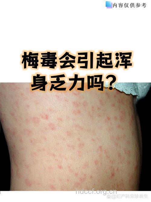 3期梅毒 没有回头路?