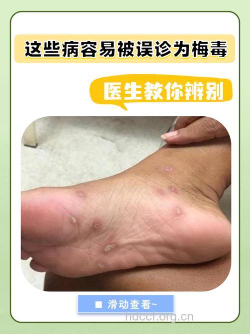 一期梅毒易误诊为那些病？