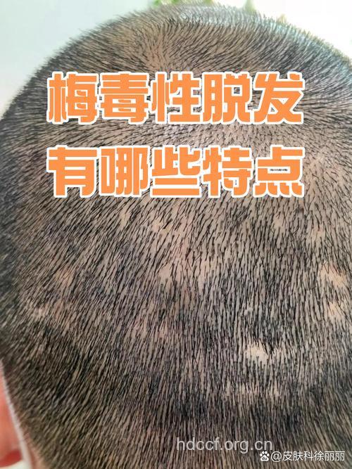 梅毒可以造成脱发吗？