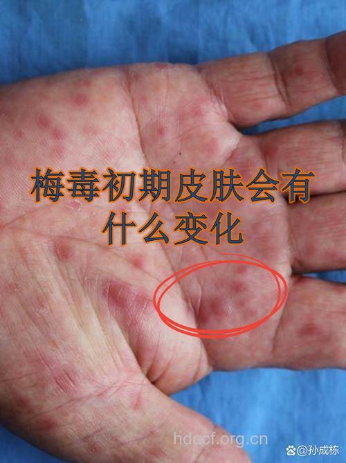 当心 梅毒的三个“变脸”手段
