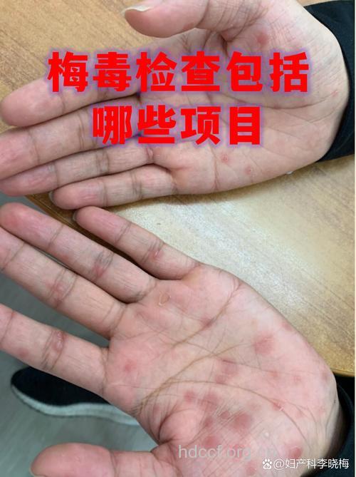三期梅毒应做哪些检查?