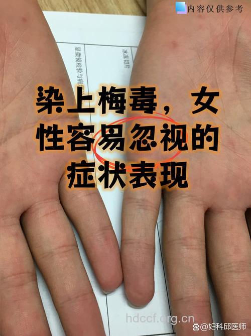 感染梅毒讳疾忌医易致晚期