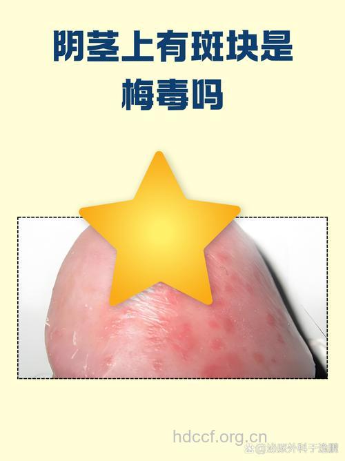 梅毒竟能诱发男性龟头炎
