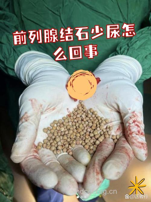 为什么前列腺多发结石