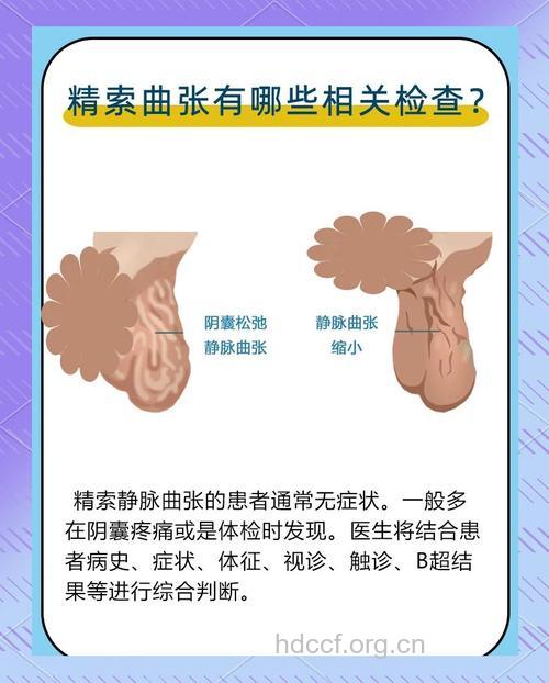 阴囊精索静脉曲张有哪些类型 日常要注意什么