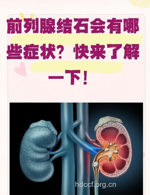 前列腺结石早期症状有哪些