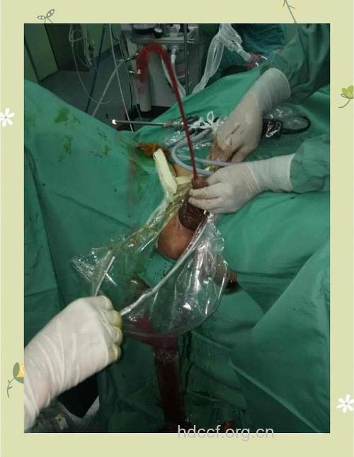 前列腺增生手术效果怎么样