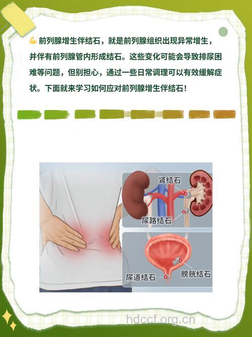 男人结石有原因 中医保护前列腺