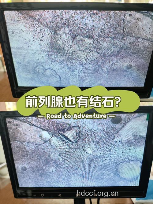 前列腺为什么会长出石头