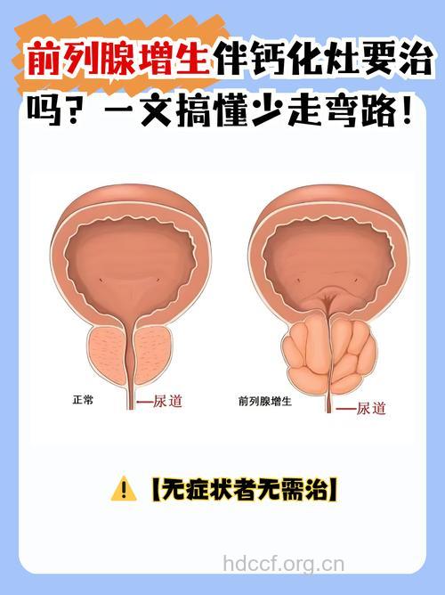男性前列腺钙化是什么