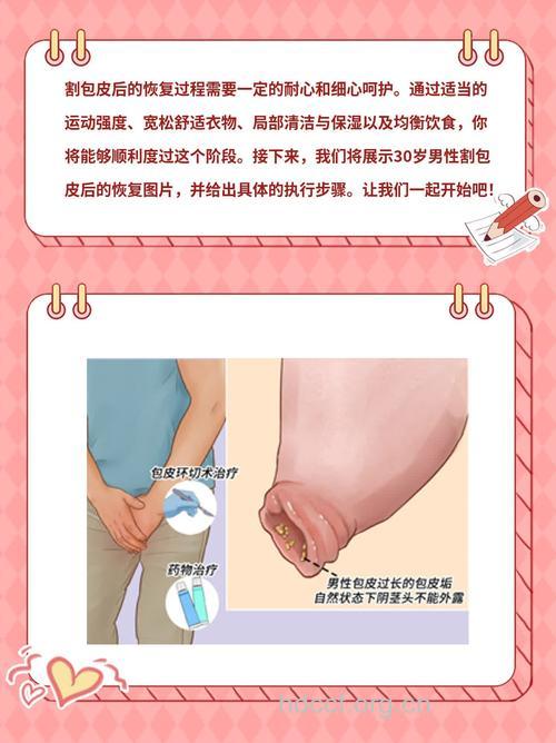 包皮包茎怎么处理 包皮手术的方法有哪些