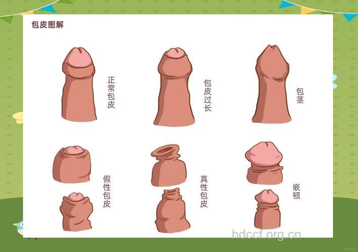 如何判定自己患有包皮包茎
