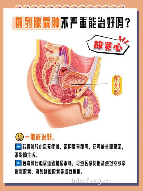 前列腺囊肿症状及原因