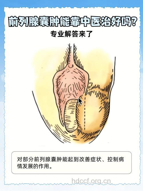 前列腺囊肿分型及症状