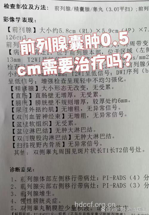 前列腺囊肿有哪些类型